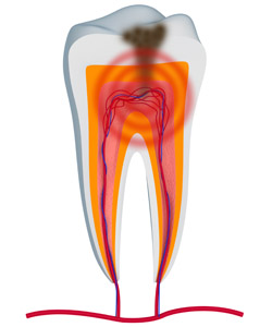 root canal dentist Monkton MD and Parkton for a toothache