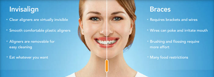 Invisalign vs braces dentist Monkton and Parkton and Sparks MD