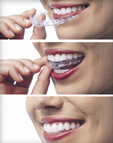 clear braces to straighten teeth Monkton dentist Parkton