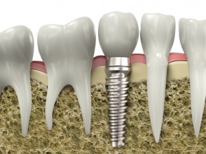 dental implants Parkton