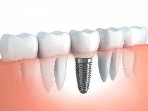 Example of a single tooth dental implant in Monkton, MD