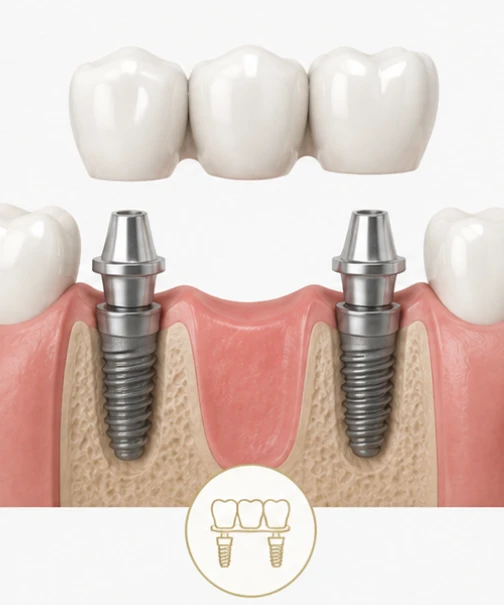 Dental Implant Bridge