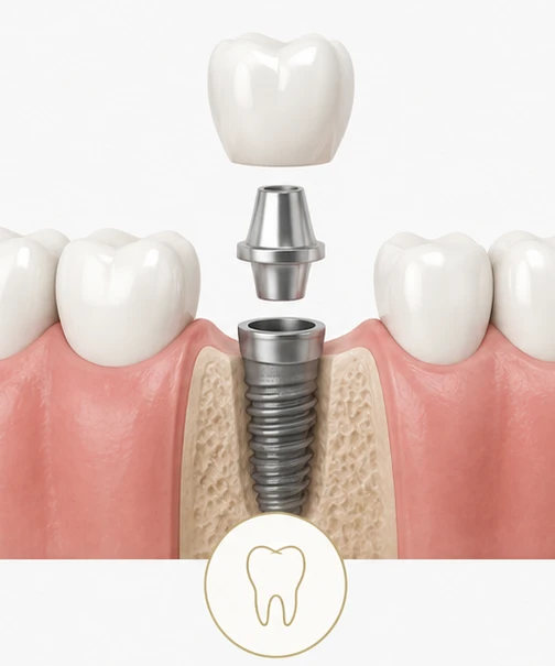Dental Implant Crown