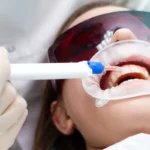 Dental Teeth Whitening