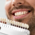Dental Veneers Monkton