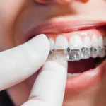 Invisalign clear alighners in Monkton