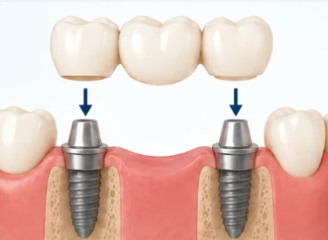 implant_supported_bridge
